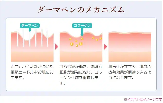 ニキビ跡治療おすすめクリニックダーマペンの仕組み画像引用品川スキンクリニック